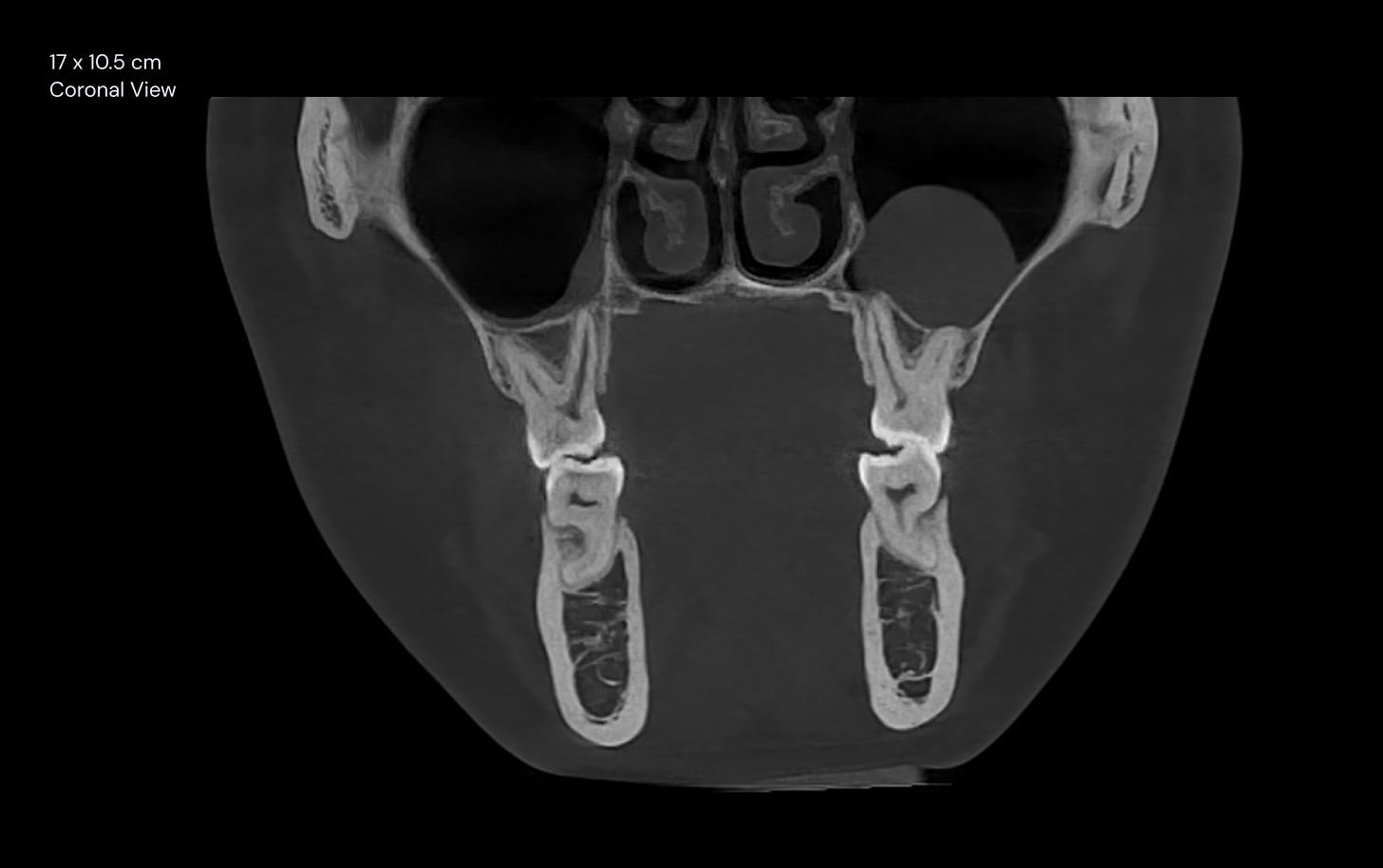 17 x 10.5 cm Coronal View